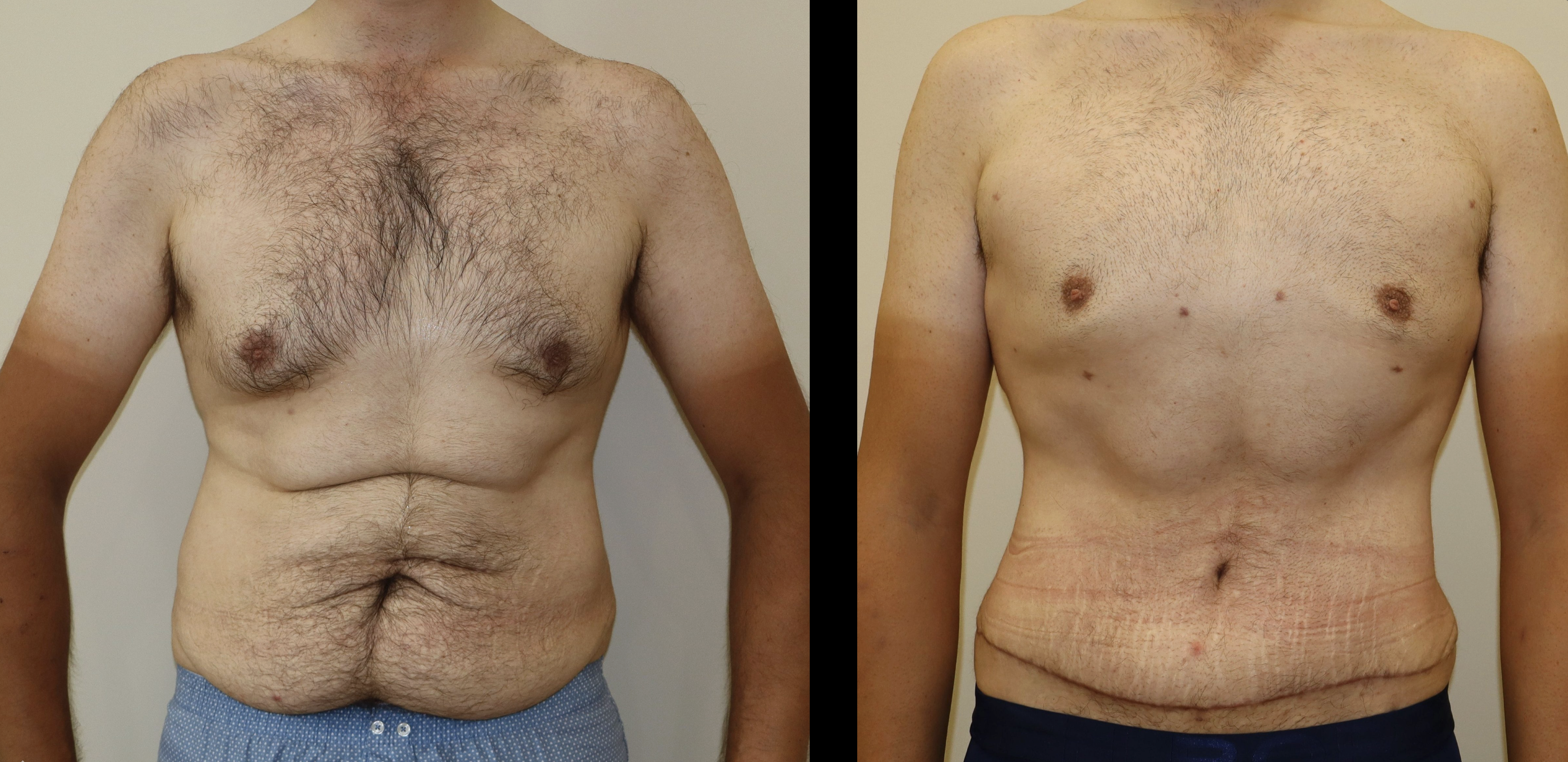 Avant/Après gynecomastie et torsoplastie